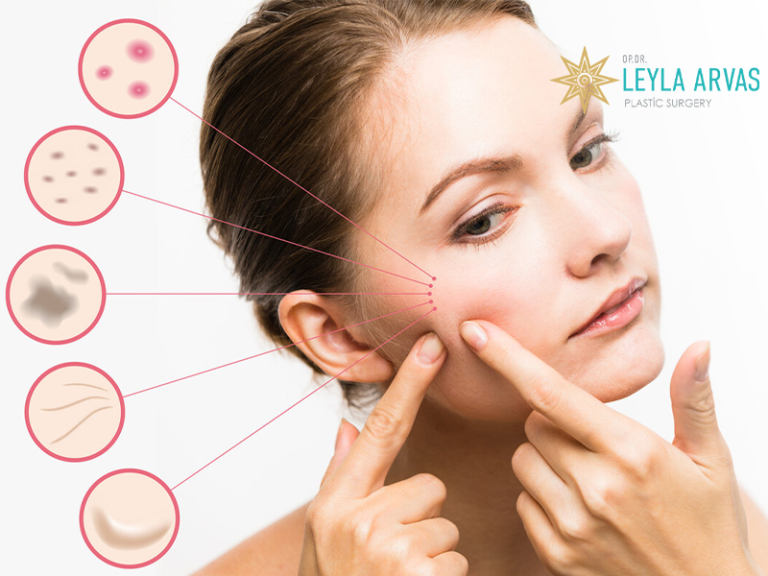 Acne Scar Removal Treatments That Work Prices